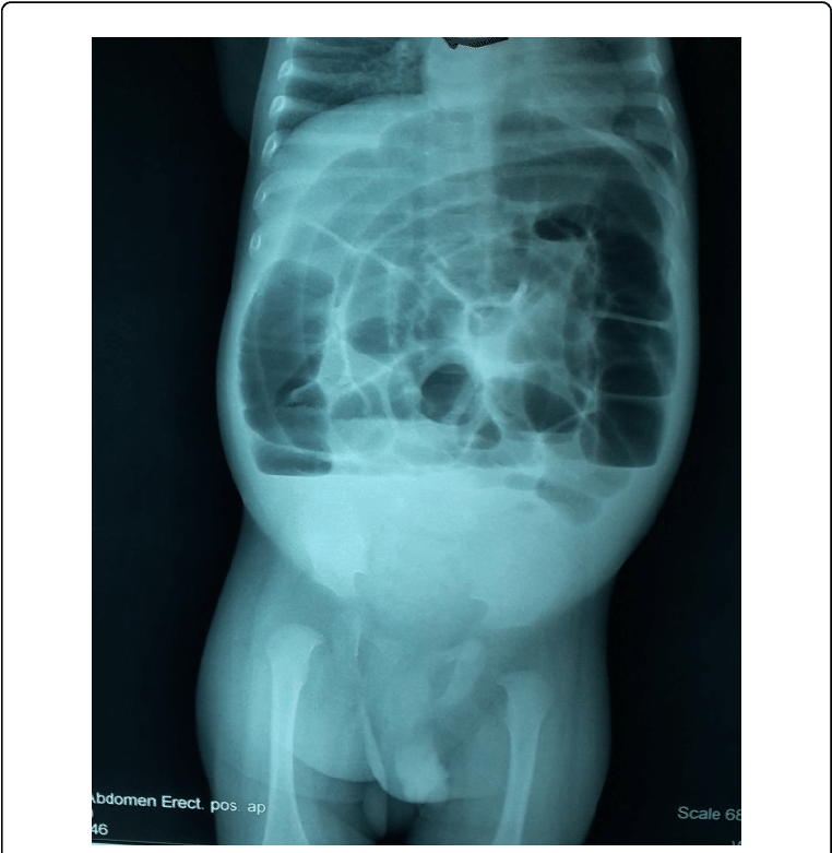 Abdominal Xray Erect Position