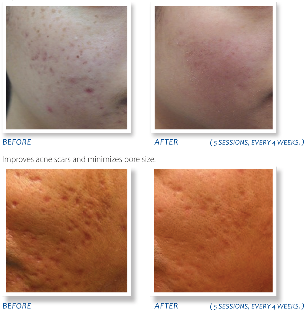 Acne Scar Treatment Before After Comparison