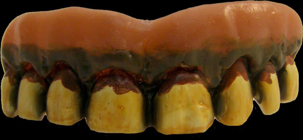 Dental Prosthesis Upper Arch