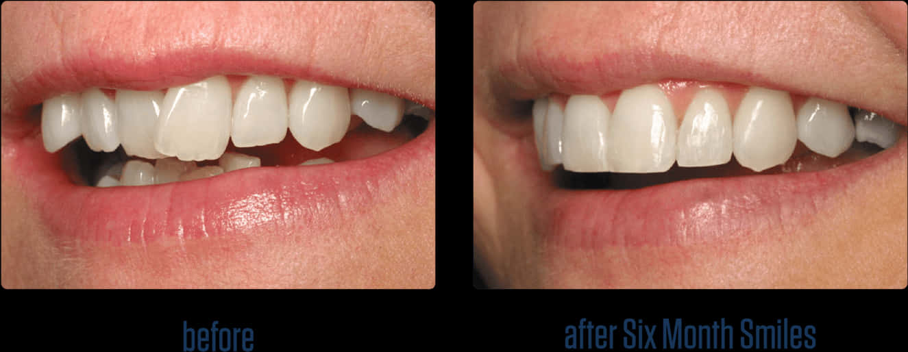 Dental_ Transformation_ Before_ After