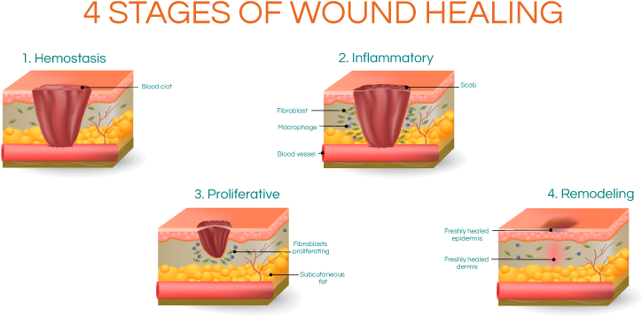 Four Stagesof Wound Healing Graphic