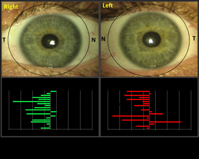 Human Eye Comparison Corneal Topography