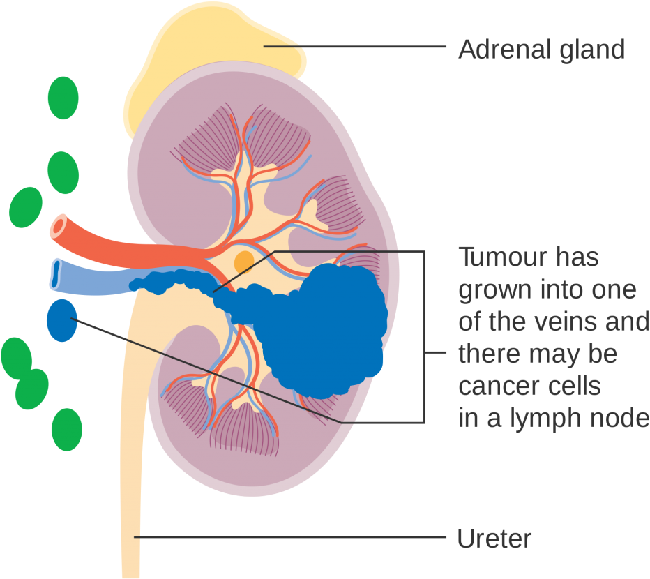 Kidney Cancer Diagram