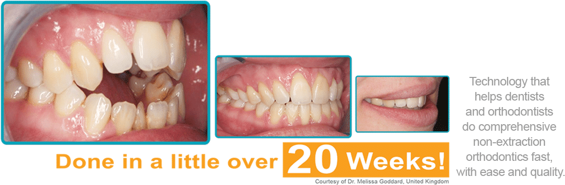 Orthodontic Treatment Progress20 Weeks