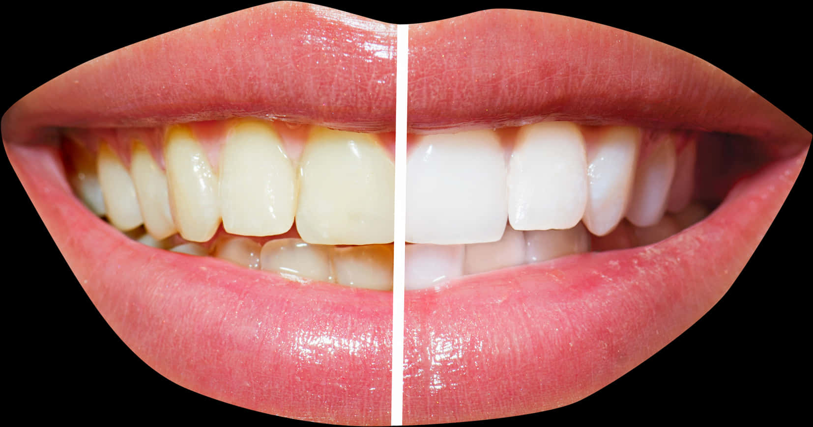 Teeth Whitening Comparison Smile.jpg