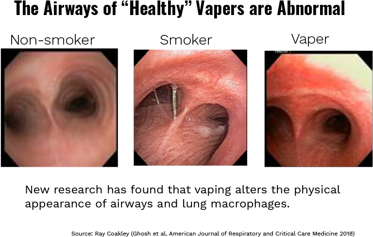 Airway Comparison Non Smoker Smoker Vaper PNG Image