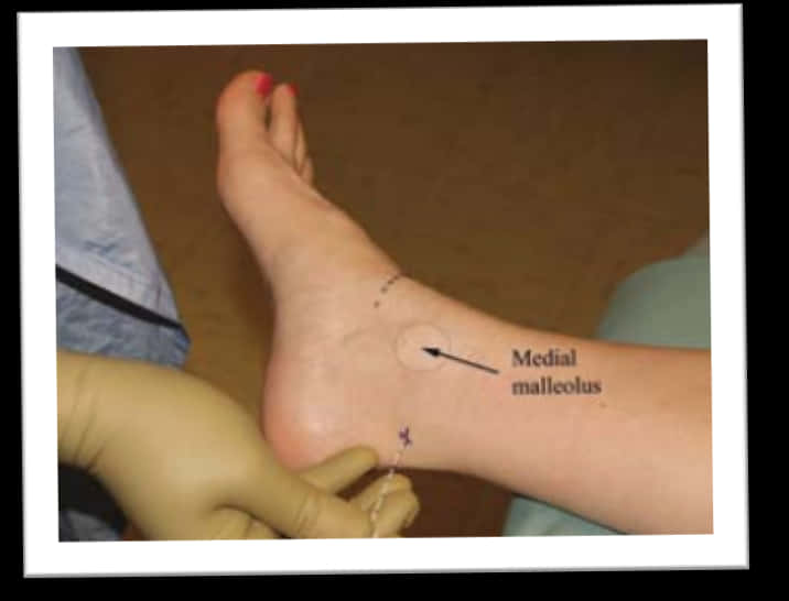 Ankle Injection Demonstration PNG Image