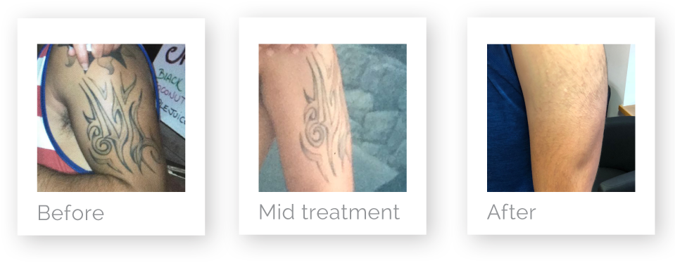 Arm Tattoo Removal Progression PNG Image