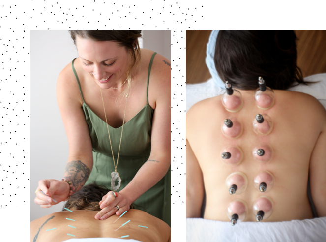 Cupping_and_ Acupuncture_ Therapy_ Session PNG Image