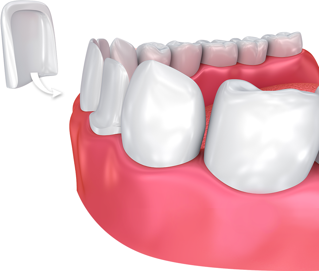 Dental Veneer Placement3 D Illustration PNG Image