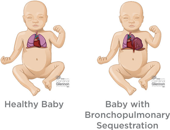 Healthy_vs_ Bronchopulmonary_ Sequstration_ Babies PNG Image