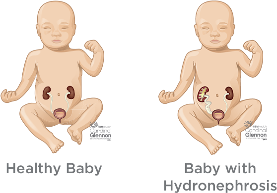 Healthyvs Hydronephrosis Baby Comparison PNG Image