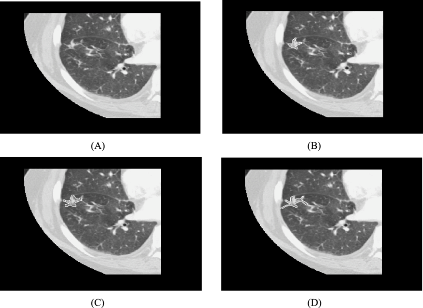 Lung C T Scan Quadrants PNG Image