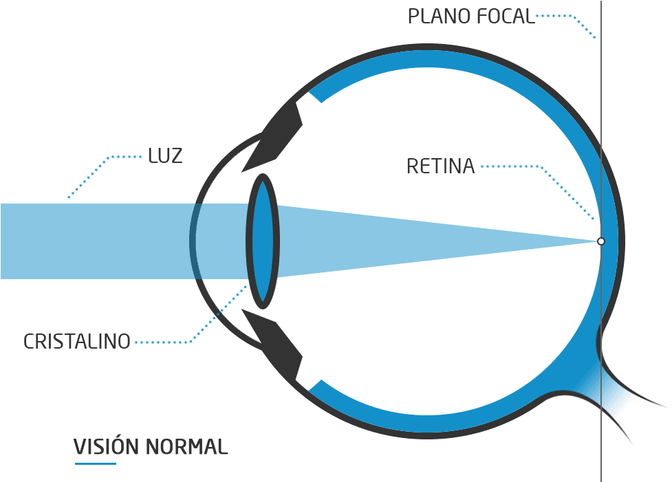 Normal Vision Light Refraction Diagram PNG Image