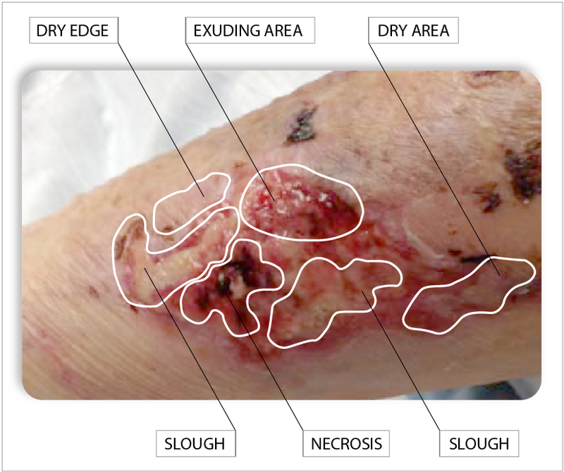 Wound Healing Stages Analysis PNG Image