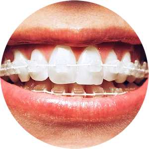 Close Up Smile With Clear Braces PNG Image