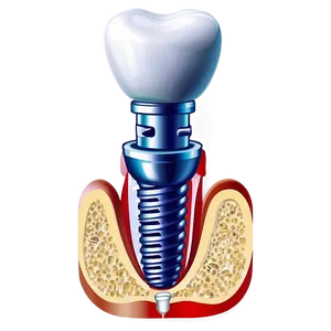 Dental Implants Diagram Png Cpe85 PNG Image