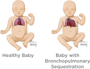 Healthy_vs_ Bronchopulmonary_ Sequstration_ Babies PNG Image