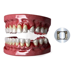 Implant-supported Dentures Png 44 PNG Image