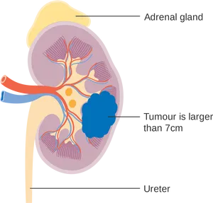 Kidney Anatomywith Tumor Illustration PNG Image