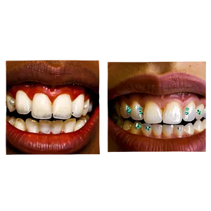 Mouth With Braces Png Ogq11 PNG Image