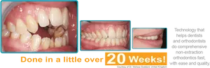 Orthodontic Treatment Progress20 Weeks PNG Image