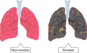 Smokervs Non Smoker Lung Comparison PNG Image