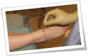 Suturing Wound Care Procedure PNG Image