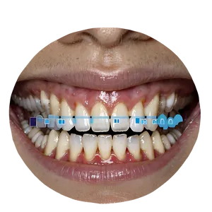 Teeth Whitening Procedure Png 06262024 PNG Image